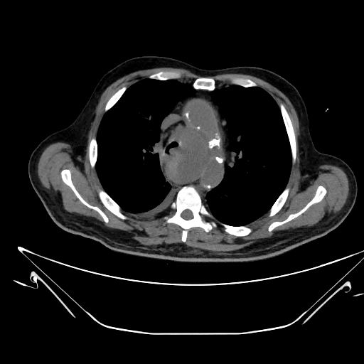 File:Aortic arch aneurysm (Radiopaedia 84109-99365 Axial non-contrast 105).jpg