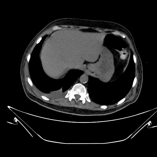 Aortic arch aneurysm (Radiopaedia 84109-99365 Axial non-contrast 248).jpg