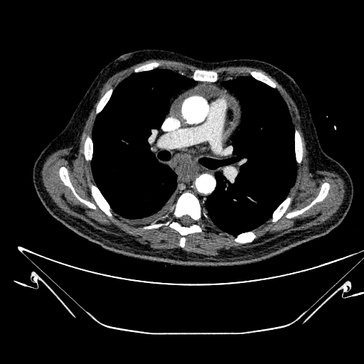 Aortic arch aneurysm (Radiopaedia 84109-99365 B 292).jpg