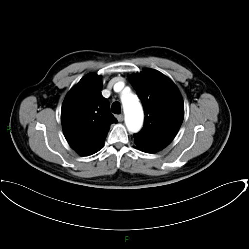Aortic arch origin of left vertebral artery (Radiopaedia 46327-50737 Axial post contrast 33).jpg