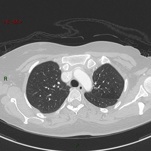 Aortic arch origin of left vertebral artery (Radiopaedia 51520-57286 Axial lung window 65).jpg