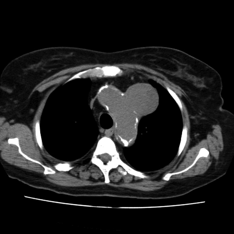 Aortic arch pseudoaneurysm (Radiopaedia 8534-9368 Axial non-contrast 19).jpg