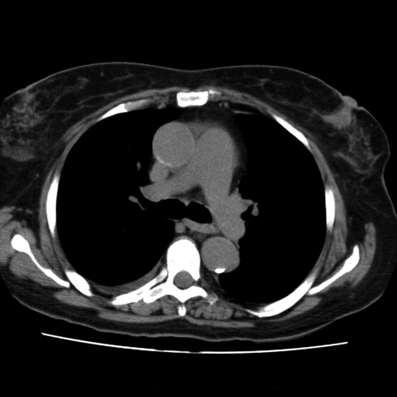 Aortic arch pseudoaneurysm (Radiopaedia 8534-9368 Axial non-contrast 31).jpg