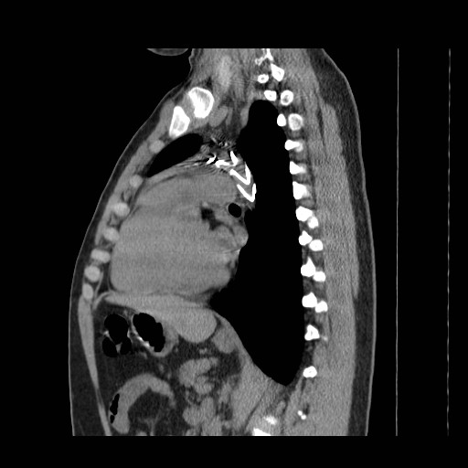 File:Aortic arch stent (Radiopaedia 30030-30595 B 17).jpg