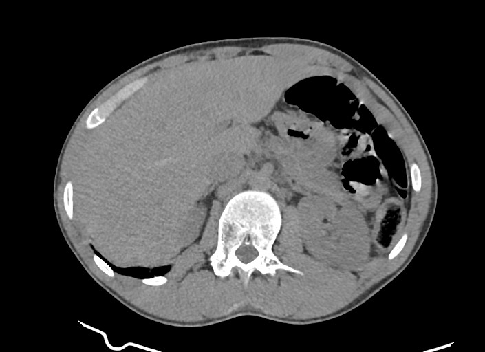 File:Aortic coarctation with aneurysm (Radiopaedia 74818-85828 A 22).jpg