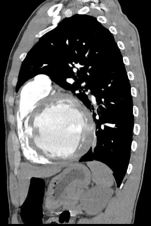 Aortic coarctation with aneurysm (Radiopaedia 74818-85828 B 111).jpg