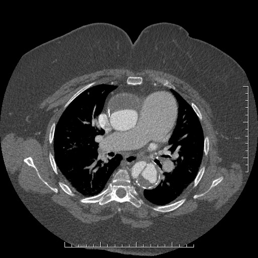 Aortic dissection- Stanford A (Radiopaedia 35729-37268 A 37).jpg