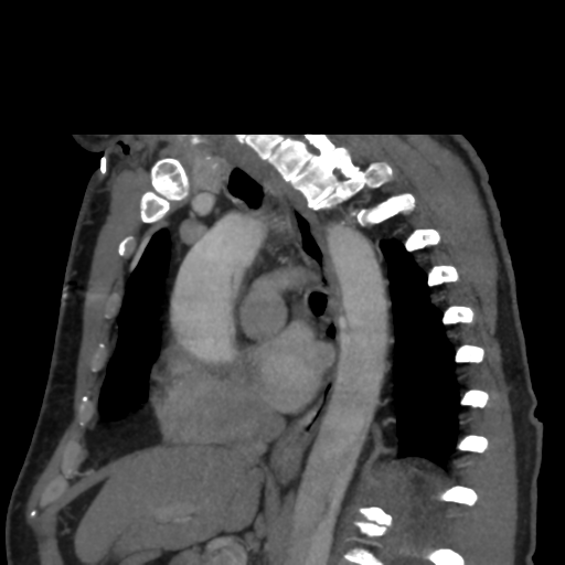 File:Aortic dissection- Stanford A (Radiopaedia 37759-39664 D 14).png