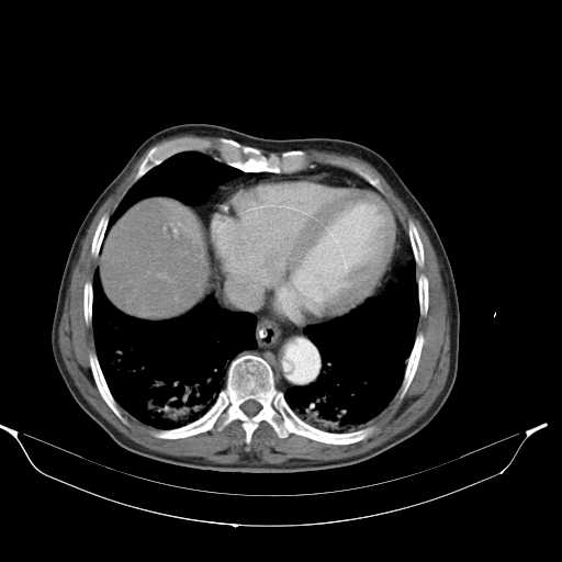 Aortic dissection- Stanford type A (Radiopaedia 22085-22085 A 30).jpg