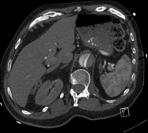 Aortic dissection (CTPA) (Radiopaedia 75506-86750 A 91).jpg