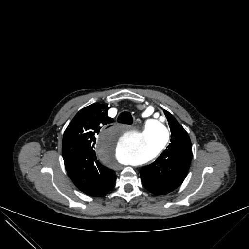 Aortic dissection (Radiopaedia 27466-27665 C+ arterial phase 33).jpg