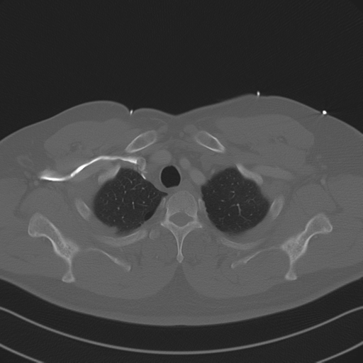 File:Aortic dissection (Radiopaedia 50763-56234 Axial bone window 20).png