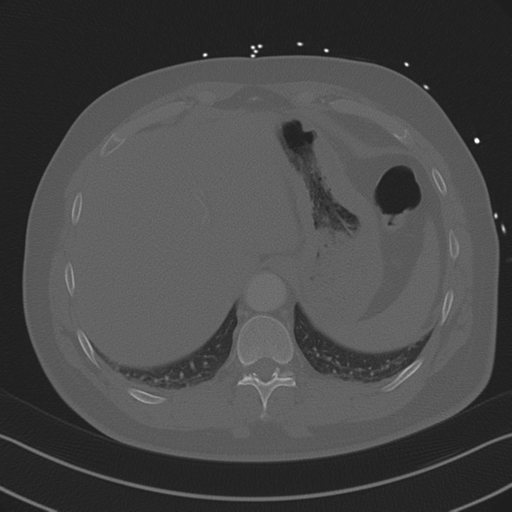 Aortic dissection (Radiopaedia 50763-56234 Axial bone window 88).png