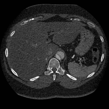 Aortic dissection (Radiopaedia 57969-64959 A 301).jpg