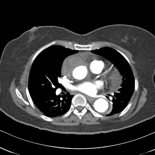 File:Aortic dissection - Stanford type A (Radiopaedia 39073-41259 A 41).png