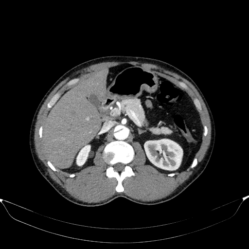 Aortic dissection - Stanford type A (Radiopaedia 83418-98500 A 68).jpg