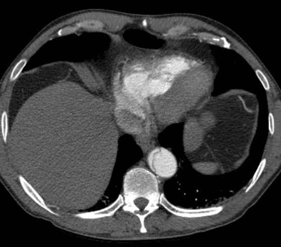 Aortic dissection - Stanford type B (Radiopaedia 73648-84437 A 91).jpg