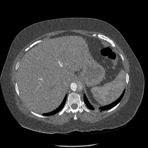 File:Aortic dissection - Stanford type B (Radiopaedia 88281-104910 A 88).jpg