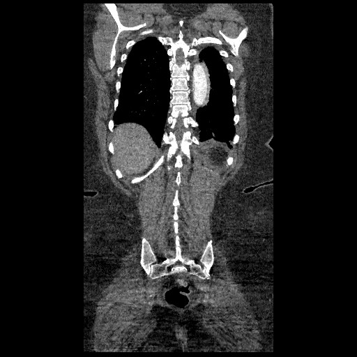 File:Aortic dissection - Stanford type B (Radiopaedia 88281-104910 B 75).jpg