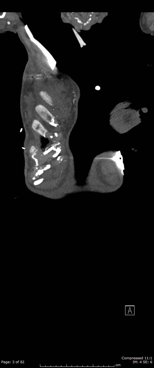 Aortic dissection with extension into aortic arch branches (Radiopaedia 64402-73204 A 3).jpg
