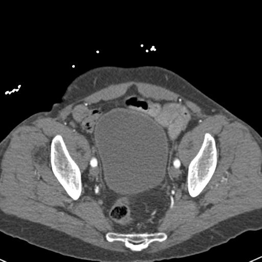 File:Aortic intramural hematoma (Radiopaedia 31139-31838 B 151).jpg