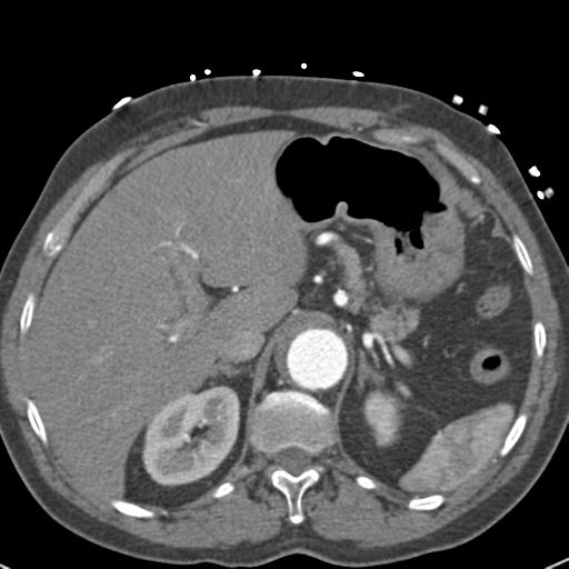 Aortic intramural hematoma (Radiopaedia 31139-31838 B 84).jpg
