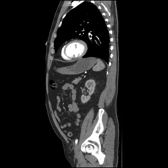 Aortic intramural hematoma (type B) (Radiopaedia 79323-92387 H 39).jpg