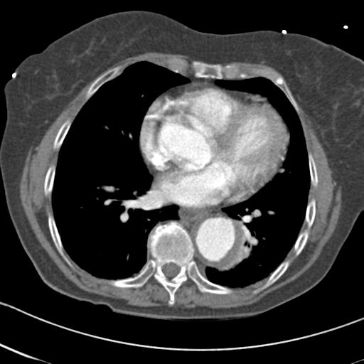 File:Aortic intramural hematoma from penetrating atherosclerotic ulcer (Radiopaedia 31137-31836 A 50).jpg