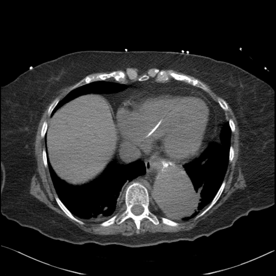 Aortic intramural hematoma with dissection and intramural blood pool (Radiopaedia 77373-89491 Axial non-contrast 73).jpg