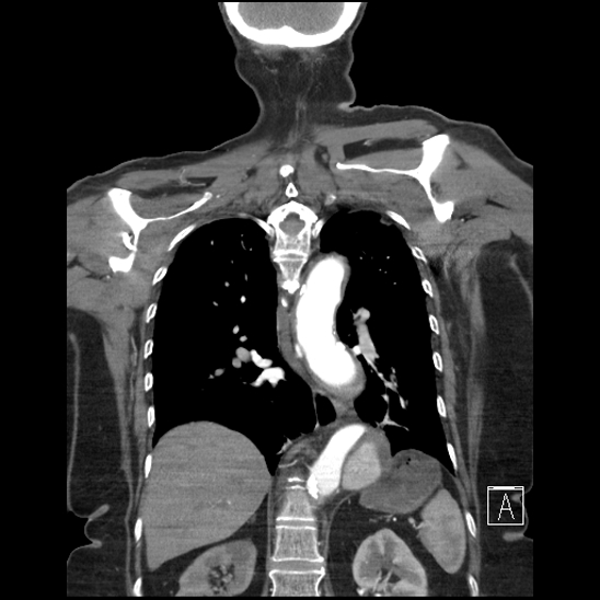 Aortic intramural hematoma with dissection and intramural blood pool (Radiopaedia 77373-89491 C 44).jpg
