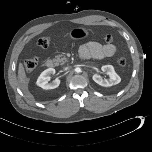 Aortic transection, diaphragmatic rupture and hemoperitoneum in a complex multitrauma patient (Radiopaedia 31701-32622 A 103).jpg