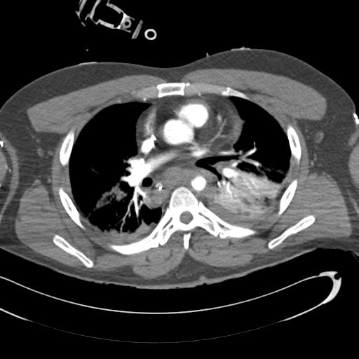 Aortic transection, diaphragmatic rupture and hemoperitoneum in a complex multitrauma patient (Radiopaedia 31701-32622 A 42).jpg