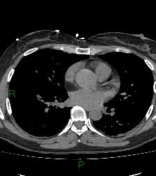 Aortic valve endocarditis (Radiopaedia 87209-103485 Axial non-contrast 57).jpg