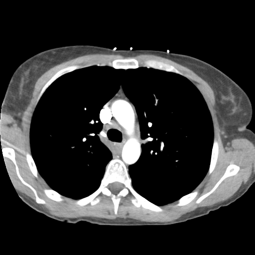 File:Aortic valve non-coronary cusp thrombus (Radiopaedia 55661-62189 B 17).png