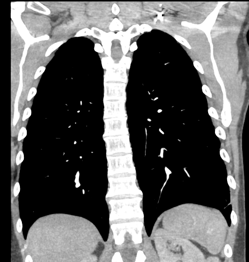 Aortic valve non-coronary cusp thrombus (Radiopaedia 55661-62189 C 58).png