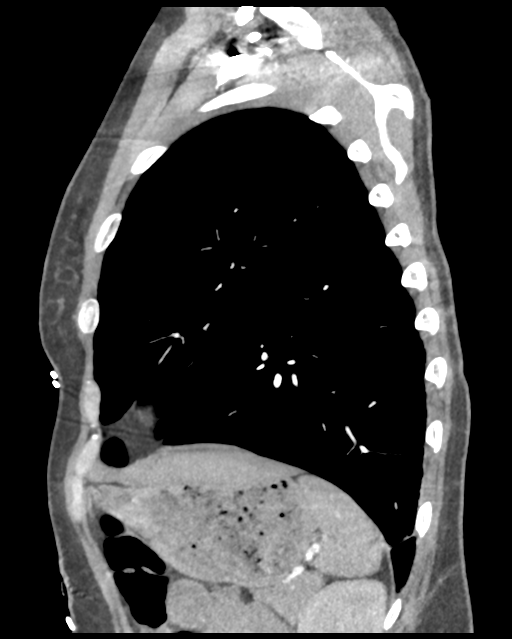 Aortic valve non-coronary cusp thrombus (Radiopaedia 55661-62189 D 13).png