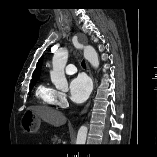 File:Aorto-coronary bypass graft aneurysms (Radiopaedia 40562-43157 C 19).png