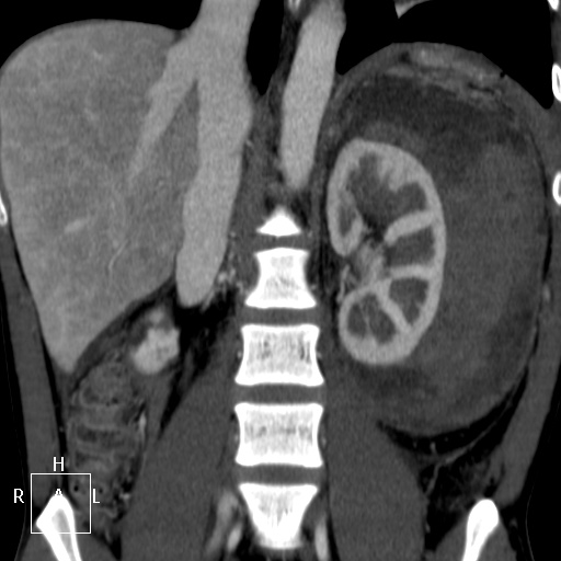 Aorto-left renal vein fistula (Radiopaedia 45534-49628 B 41).jpg