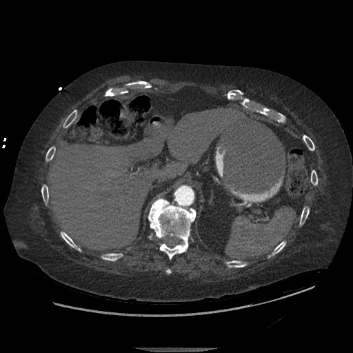 Aortoesophageal fistula with endovascular repair (Radiopaedia 73781-84592 Axial C+ CTPA 169).jpg