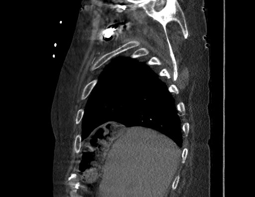 Aortoesophageal fistula with endovascular repair (Radiopaedia 73781-84592 Sagittal C+ CTPA 26).jpg