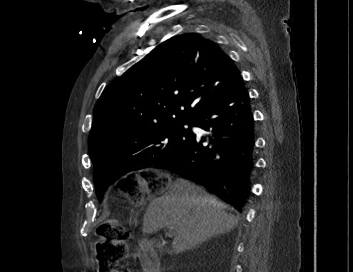 Aortoesophageal fistula with endovascular repair (Radiopaedia 73781-84592 Sagittal C+ CTPA 64).jpg