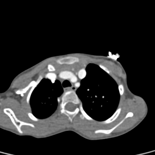 File:Aortopulmonary window, interrupted aortic arch and large PDA giving the descending aorta (Radiopaedia 35573-37074 B 17).jpg