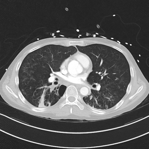 Apical bullous disease in a heavy smoker (Radiopaedia 33067-34092 Axial lung window 35).png