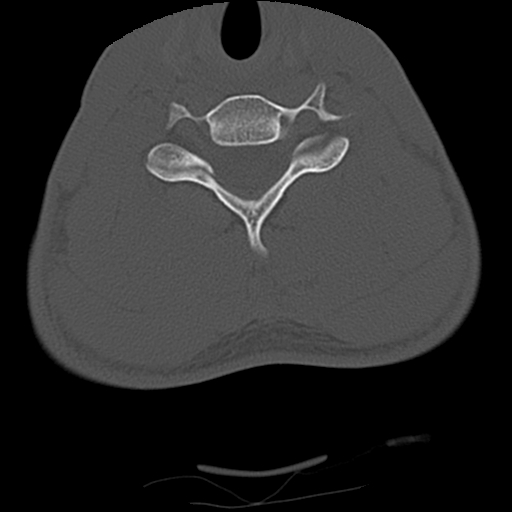 Apical pneumothorax on cervical spine CT (Radiopaedia 45343-49368 Axial bone window 62).jpg