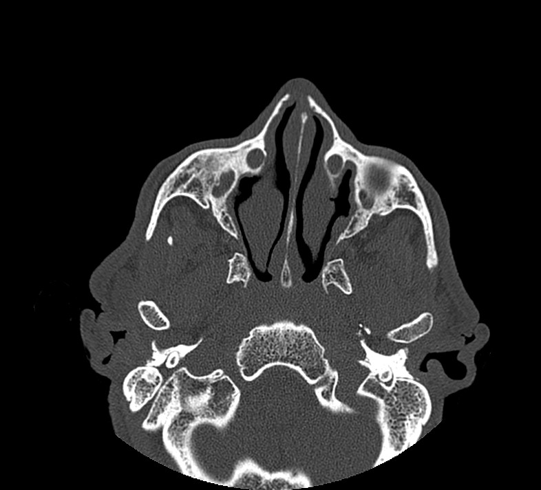 Aplastic maxillary sinuses (Radiopaedia 60030-67561 Axial non-contrast 31).jpg