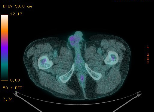 Appendiceal adenocarcinoma complicated by retroperitoneal abscess (Radiopaedia 58007-65041 Axial PET-CT 202).jpg