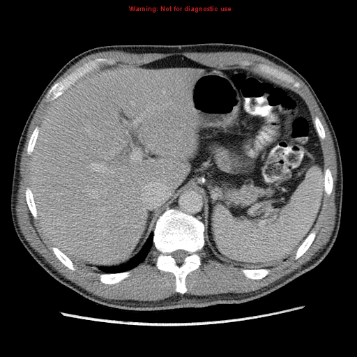 Appendicitis and renal cell carcinoma (Radiopaedia 17063-16760 A 11).jpg