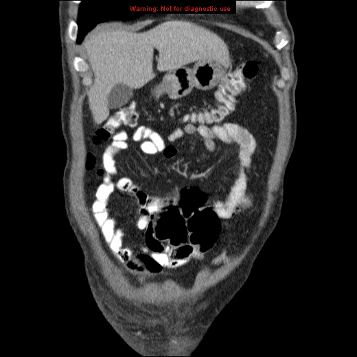 File:Appendicitis mass in inguinal hernia (Radiopaedia 26858-27029 B 11).jpg