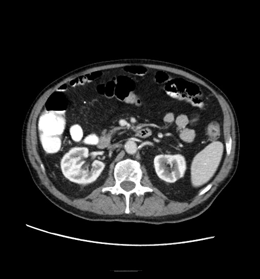 Appendicitis with localized perforation and abscess formation (Radiopaedia 49035-54130 A 38).jpg