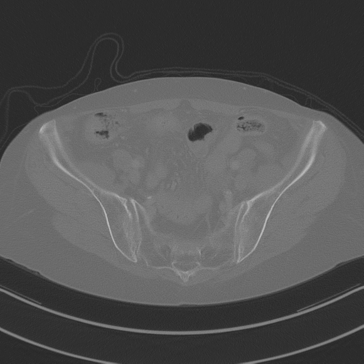 April fools' 2019- calcified peritoneal arachnoidosis (Radiopaedia 67273-76636 Axial bone window 40).png